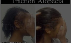 Hairstyles For Alopecia Sufferers 0