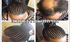 Hairstyles For Alopecia Sufferers 3