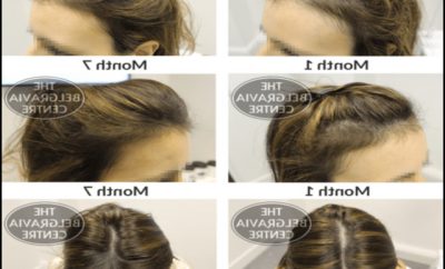 Hairstyles For Alopecia Sufferers 9