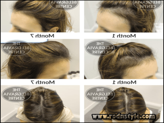 hairstyles-for-alopecia-sufferers-9 Learn Exactly How I Improved Hairstyles For Alopecia Sufferers In 2 Days